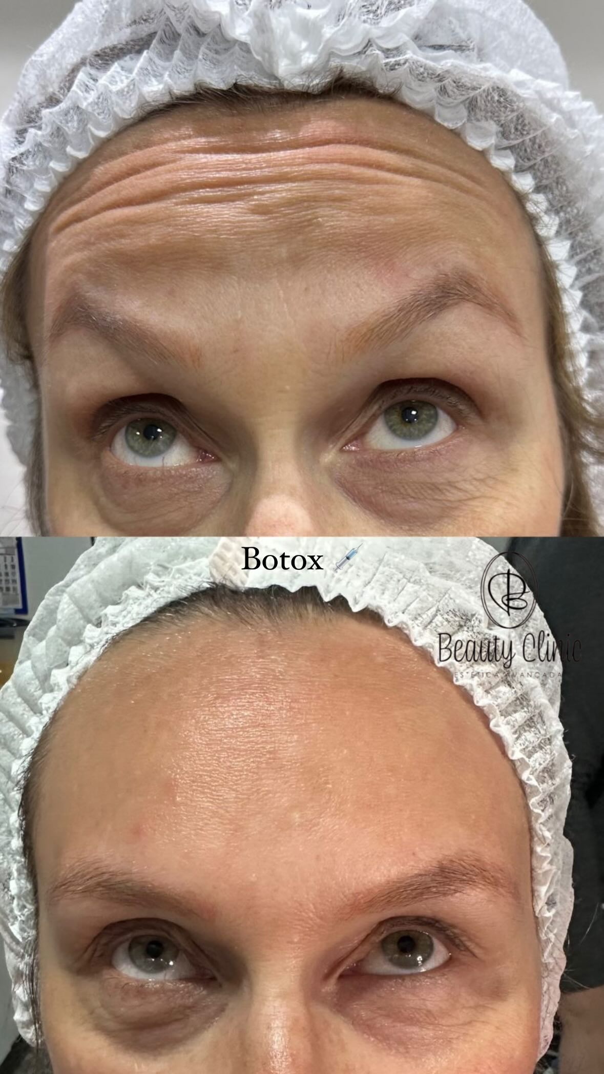 Botox e Preenchimento em Vila Andrade Morumbi | Beauty Clinic